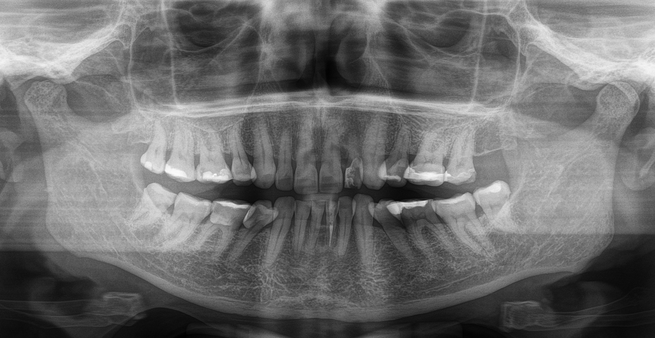 Radiografia panorâmica usada na demonstração